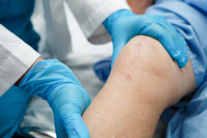 does medicare cover knee replacement